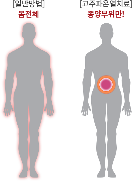 고주파온열치료는 종양부위만